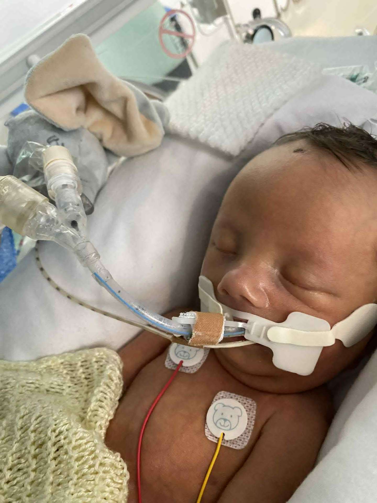 Close-up of Noah with breathing support